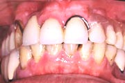 術前：保険義歯装着状態