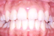 歯列矯正：術後