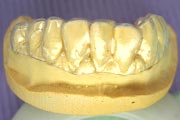 歯の漂白模型２